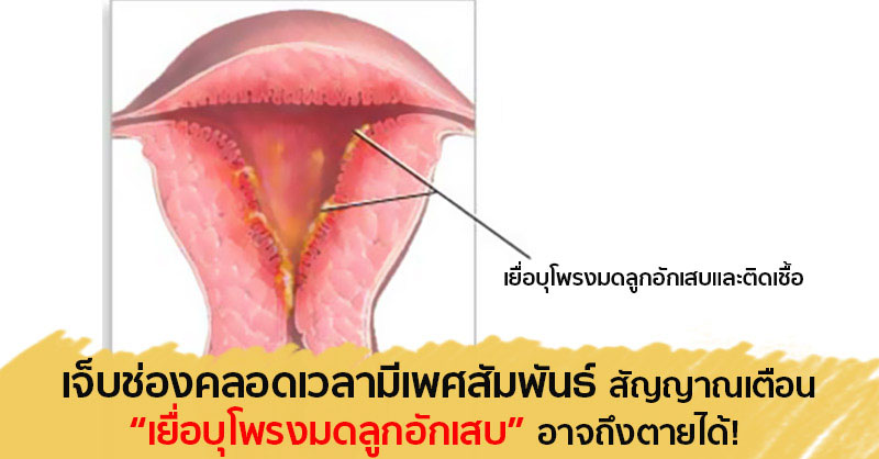 เยื่อบุโพรงมดลูกอักเสบ